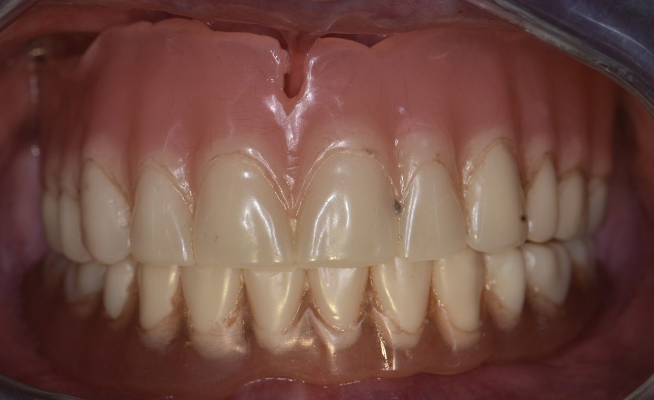 All-on-4 mandibular con prótesis fija cerámica - Antes