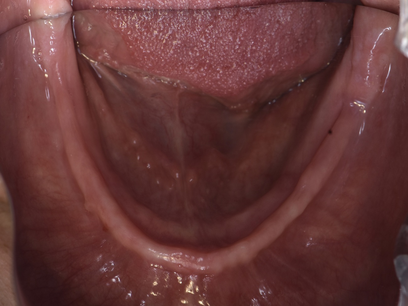 All-on-4 mandibular con prótesis fija cerámica - Antes