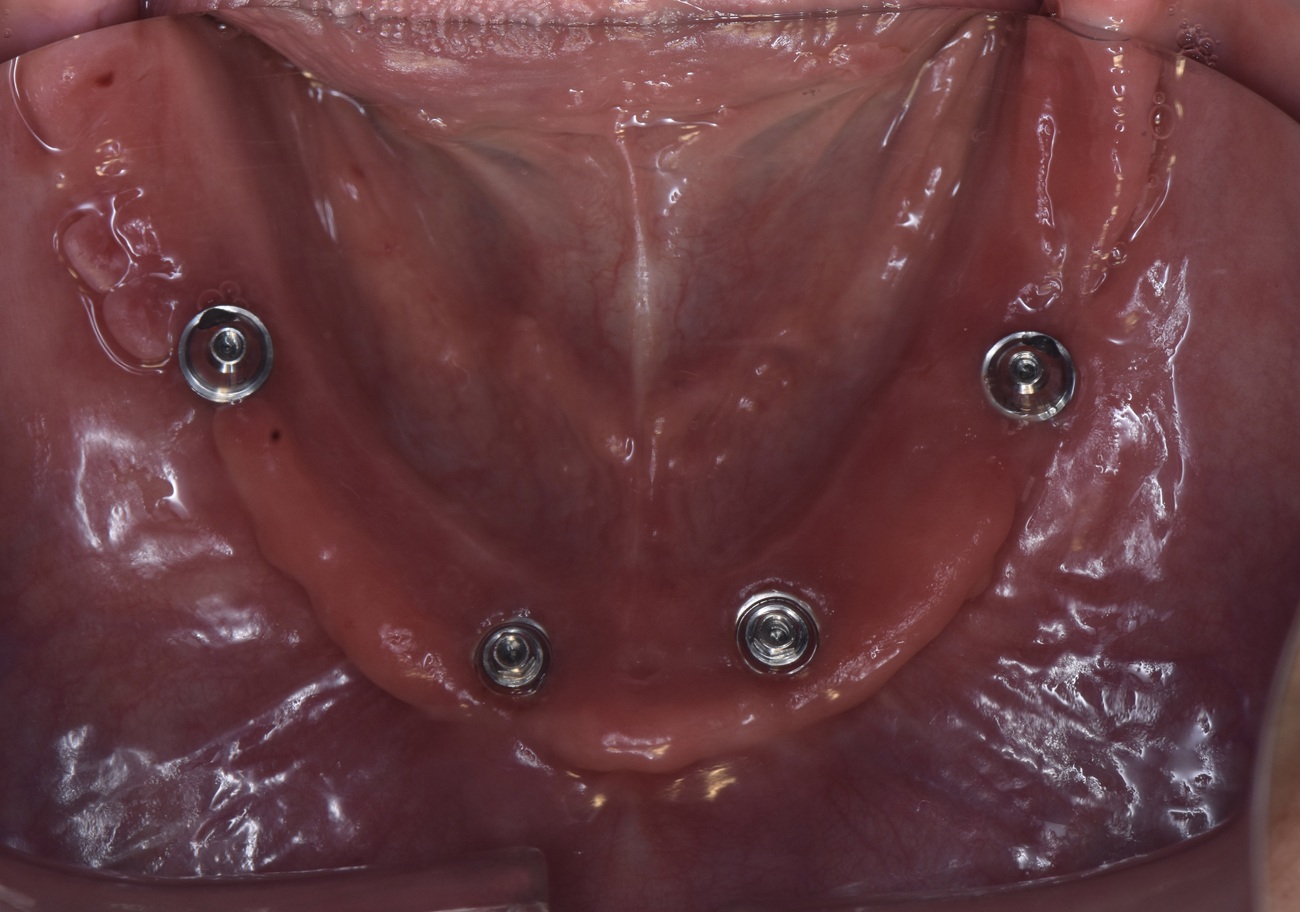 All-on-4 mandibular con prótesis fija cerámica - Después