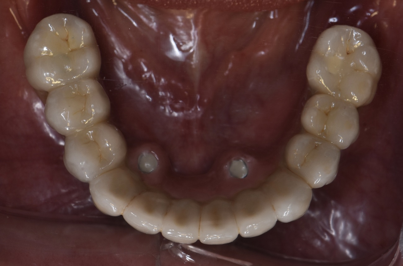All-on-4 mandibular con pr&oacute;tesis fija cer&aacute;mica - Despu&eacute;s