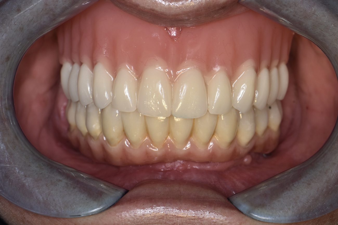 All-on-4 mandibular con prótesis fija cerámica - Después