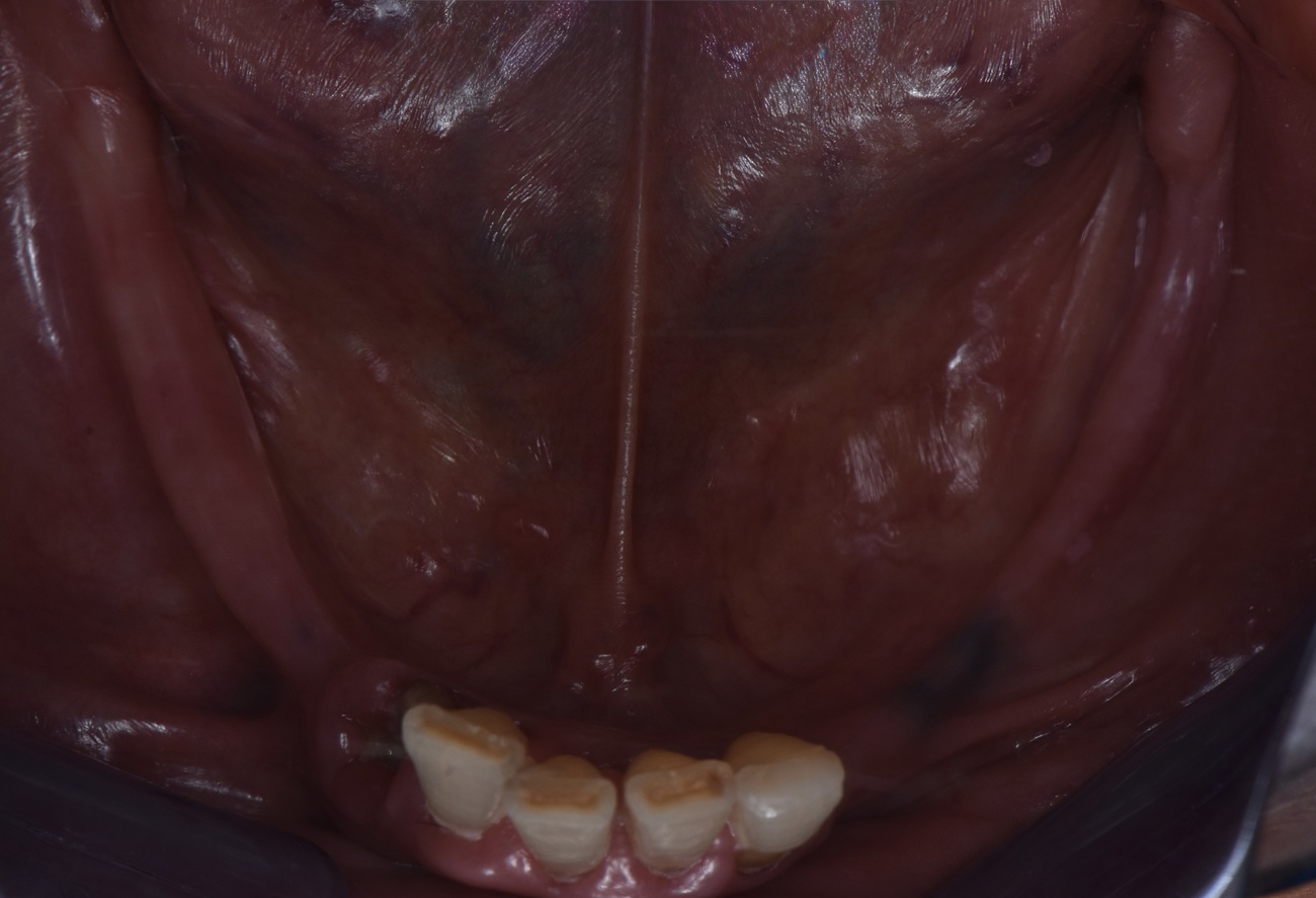 Mandíbula parcialmente edéntula con extracción, regularización e implantes - Antes