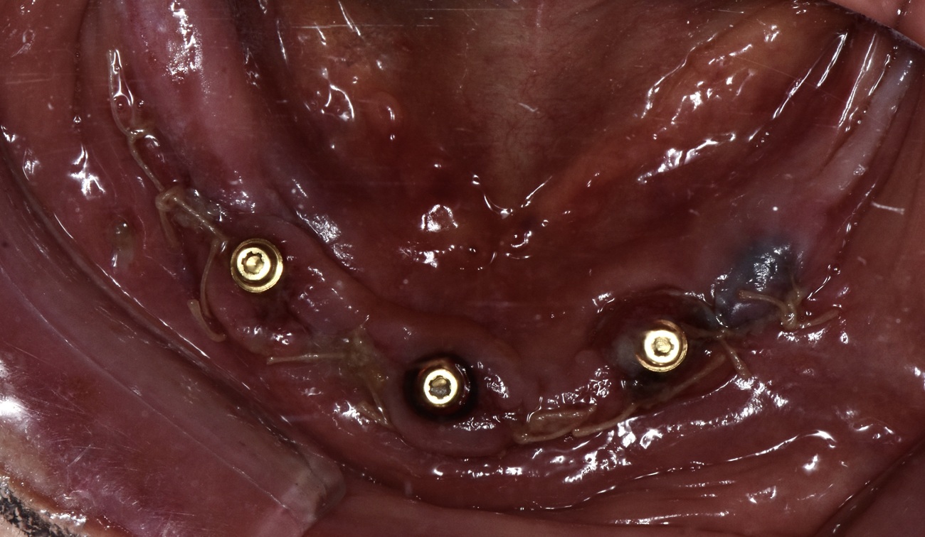 Mandíbula parcialmente edéntula con extracción, regularización e implantes - Después