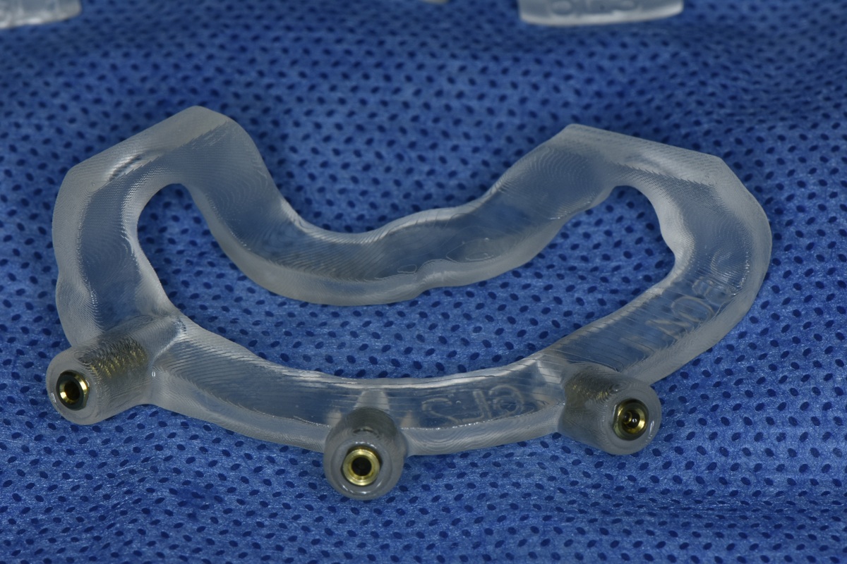 Guided dental implant surgery at Smile Implant Center in Mexico City